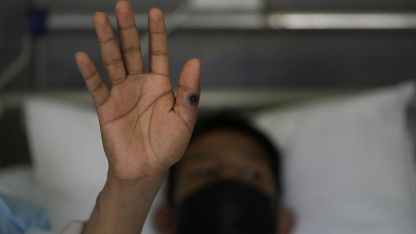 Оспа обезьян: Казахстан усиливает санэпидконтроль на границах Оспа обезьян: Казахстан усиливает санэпидконтроль на границах