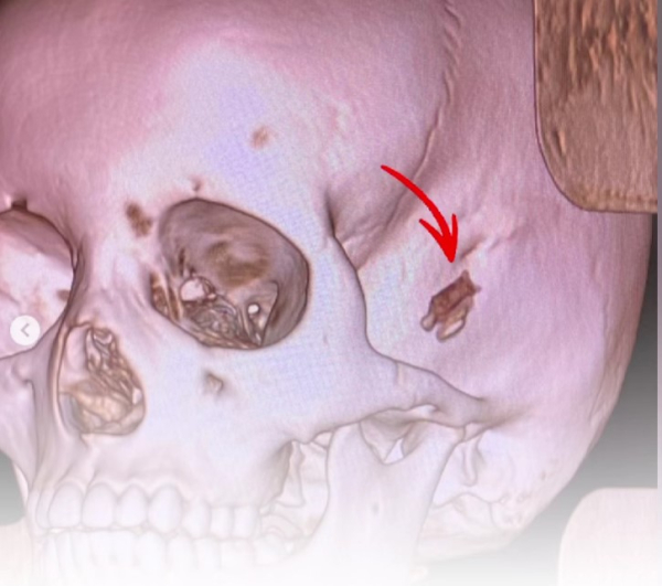 
Кусочек ветки в голове ребёнка обнаружили врачи в Павлодаре спустя пять лет после травмы
