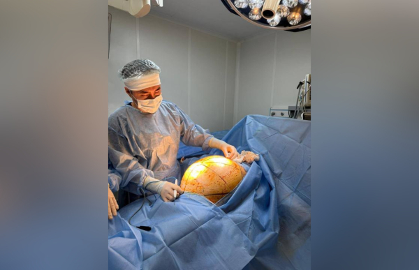 В Алматы спасли пациентку с опухолью в 25 килограммов